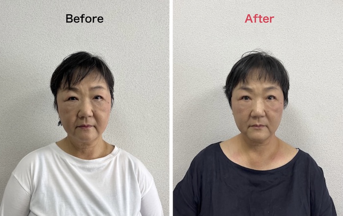 小顔モニター60代女性