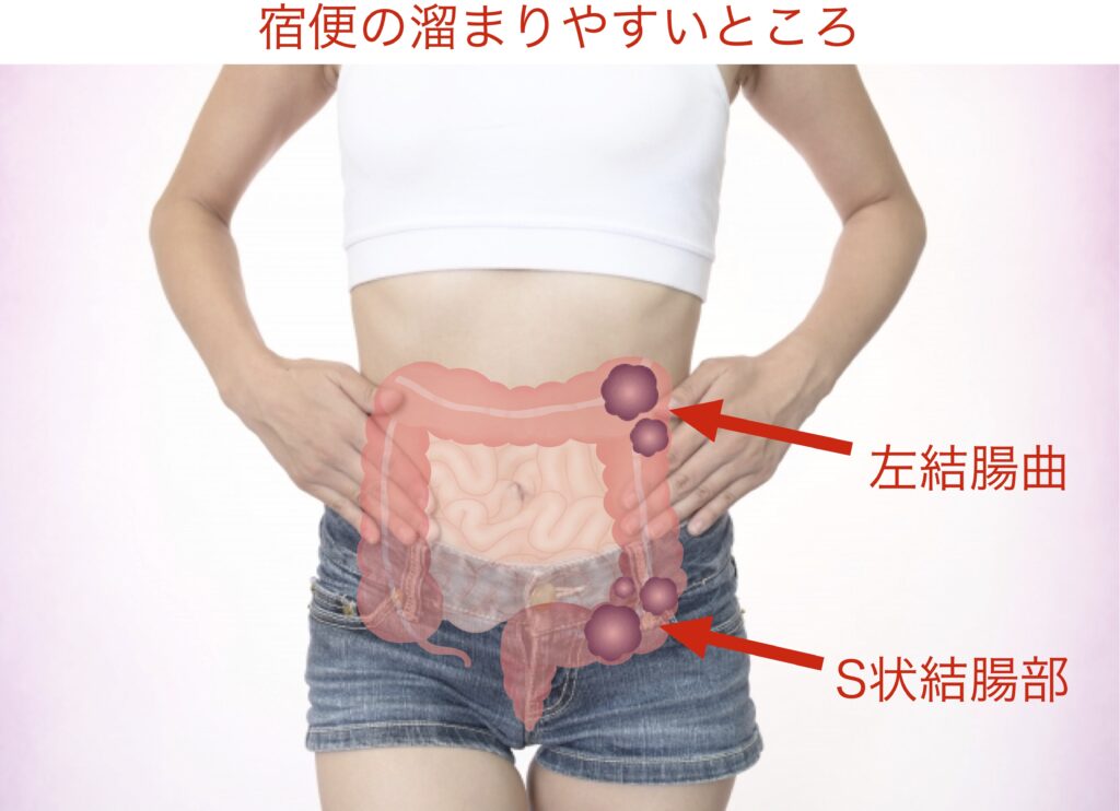 宿便の溜まりやすい所