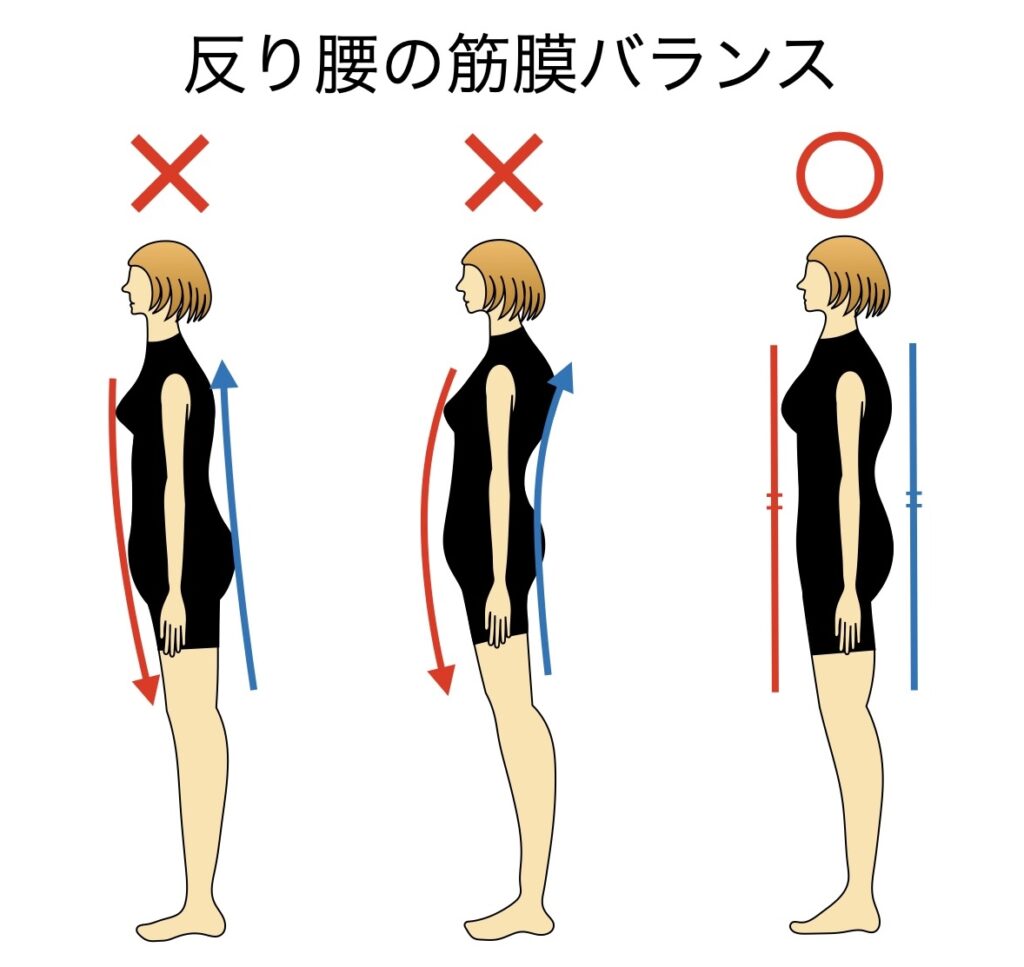 反り腰の筋膜バランス